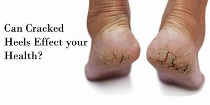 How Cracked Heels Can Hurt Your Health 